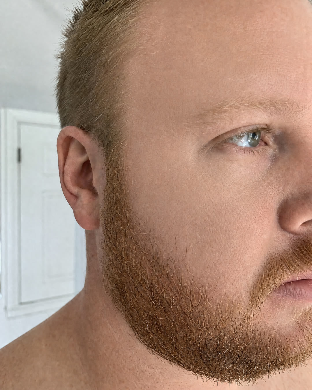 After — Breakouts and redness, 4 weeks