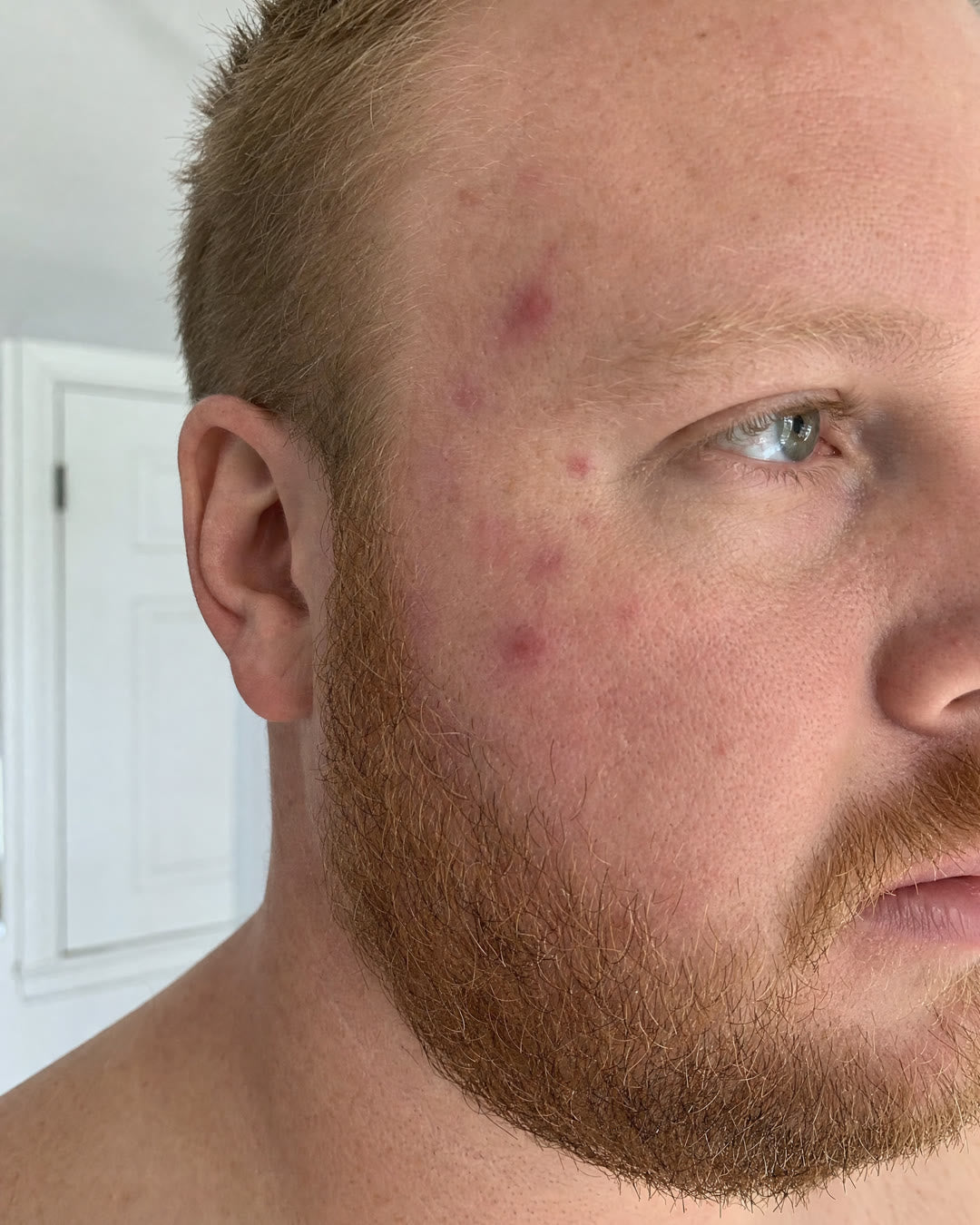 Before — Breakouts and redness, 4 weeks