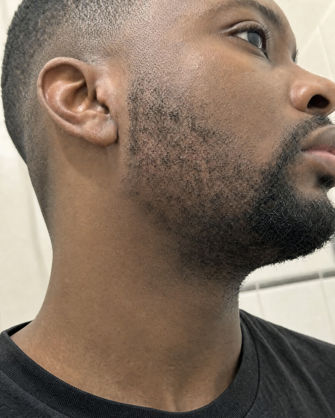 After — Razor bumps along the jaw