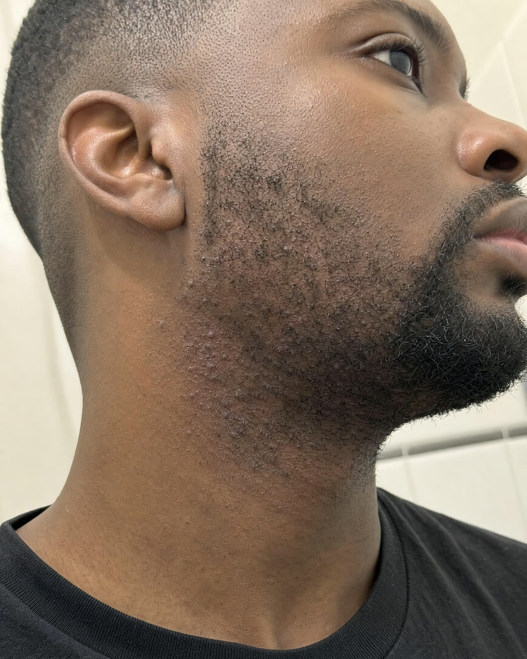 Before — Razor bumps along the jaw