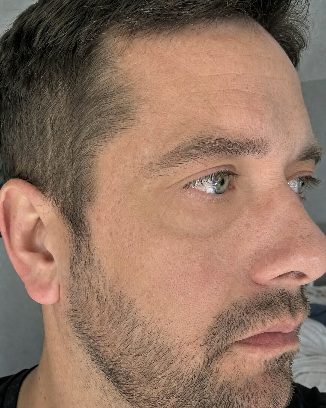 After — Dark circles