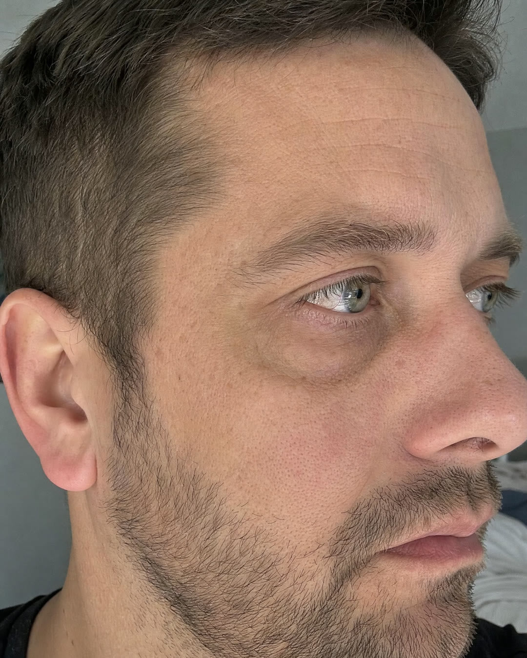 Before — Dark circles