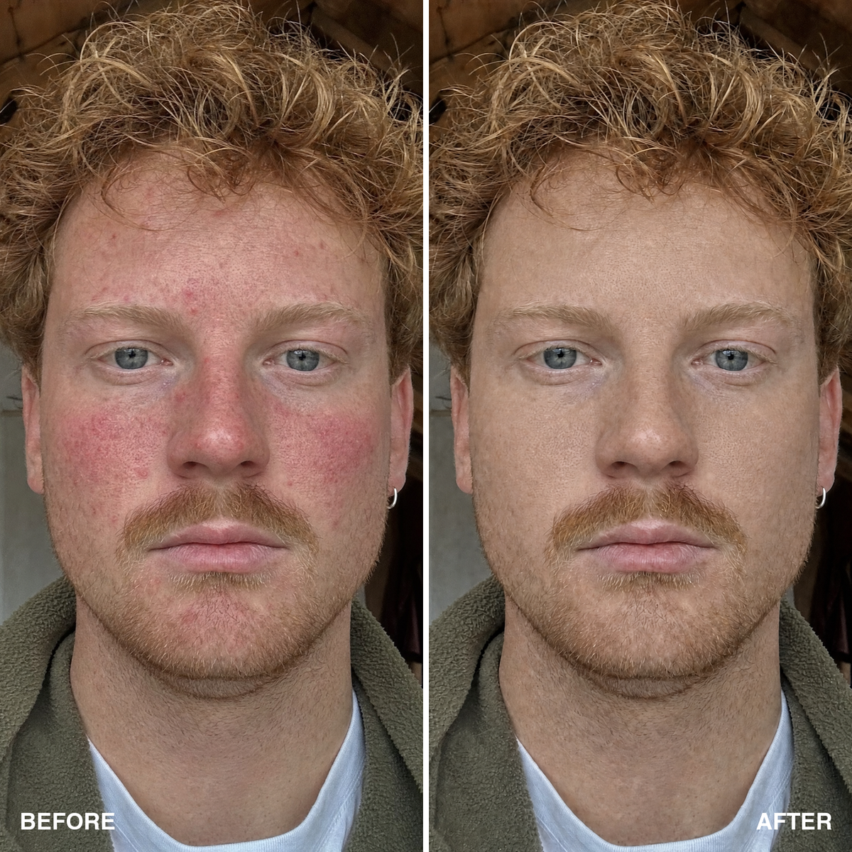Before & after — rosacea and facial redness